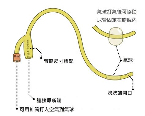 導尿管放置天數